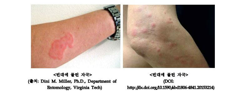 빈대 물린 자국