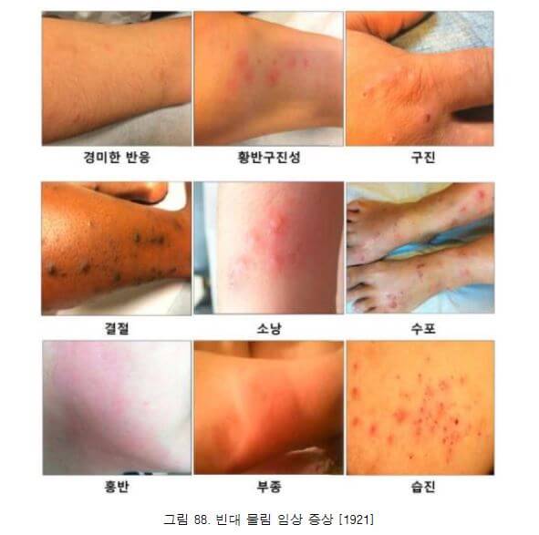 빈대 물림 임상증상